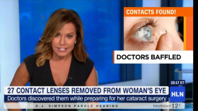She thought she lost her contact lens. Doctors find 27 lens  behind her eyeball. by Videot Virale